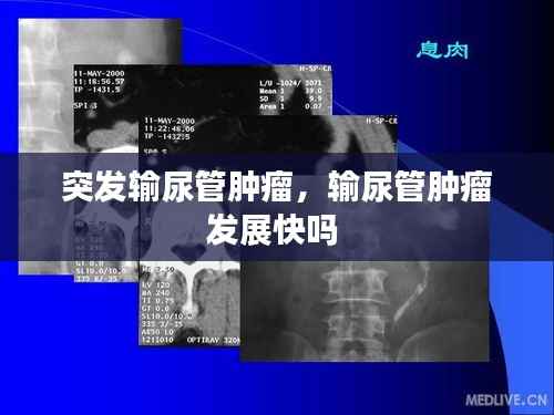 突发输尿管肿瘤,输尿管肿瘤发展快吗